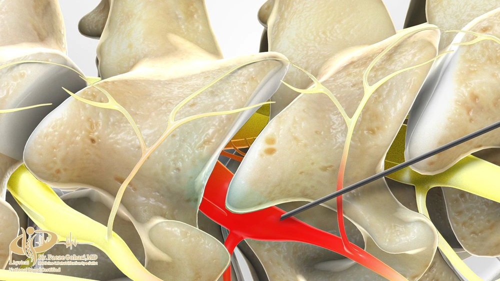 تزریق به محل عصب