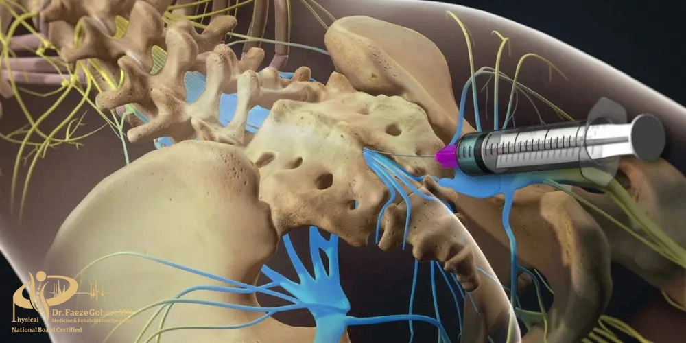بلوک عصبی لگن و دنبالچه