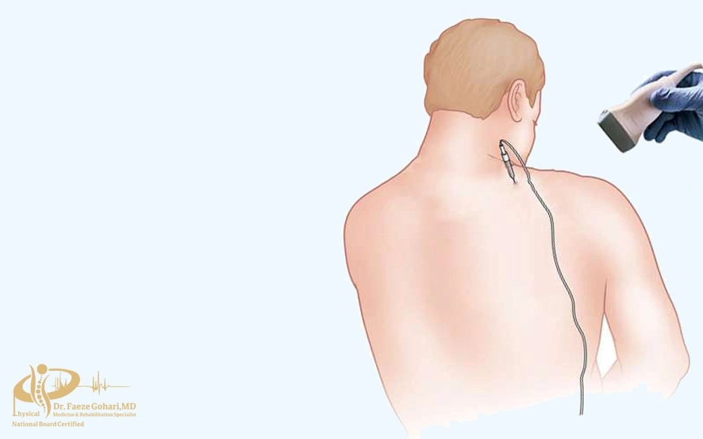 بلوک عصبی شانه