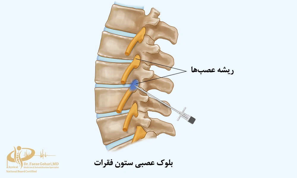 بلوک عصبی ستون فقرات