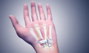 سندروم تونل کارپال